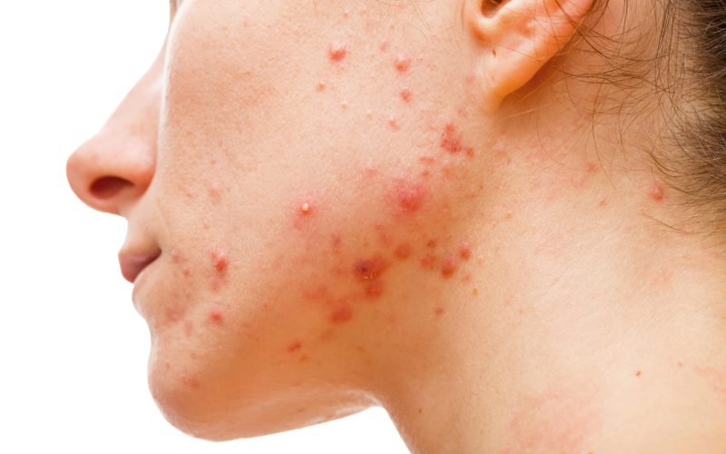 Acne_share